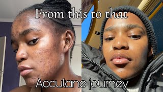 My Accutane journey  Going back on accutane and its side effects [upl. by Eniruam26]