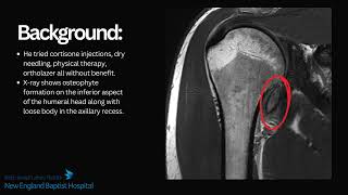 Case Presentation Comprehensive Arthroscopic Management for Synovial Chondromatosis [upl. by Koeninger]