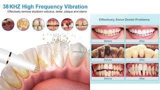 Tartar Remover Deep Cleaning With Tartar Build Up At The Dentist [upl. by Anilegna365]