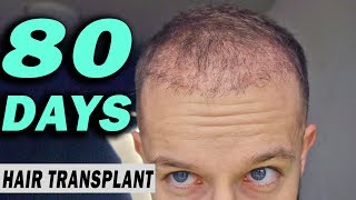 FUE Hair Transplant 80 DAYS post op Istanbul Turkey GROWTH STAGE [upl. by Alenson]