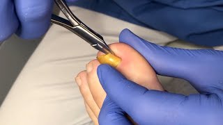 Usuwanie wrastającego fragmentu paznokcia  Ingrown toenail removal [upl. by Muriah]