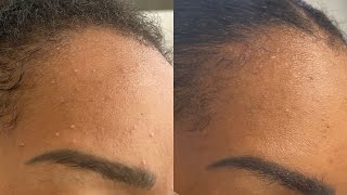 HOW I CLEARED MY CONGESTED SKIN IN 10 DAYS PM ROUTINE  JOURNEY TO COURTNEY [upl. by Kuhn559]