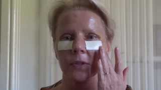 6 Blepharoplasty Eyelid Lift Diary Day 5 After Surgery [upl. by Trin]