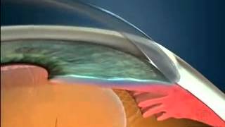 Lecture Angle Closure Glaucoma Primary and Secondary [upl. by Mortensen776]