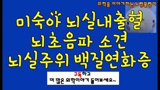 미숙아 뇌실내출혈 두개내 출혈과 뇌실주위 백질연화증periventricular leukomalacia [upl. by Siriso667]