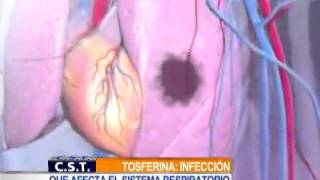 Tosferina una infección respiratoria aguda  NTN24com [upl. by Eeliab]