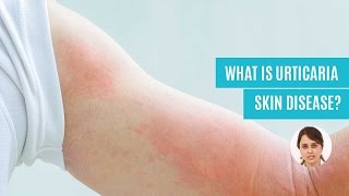 What Is Urticaria Hives Skin Disease Causes Symptoms amp Diagnosis [upl. by Lamak449]