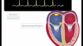 ECG Rhythm Review Sinus Rhythm Sinus Bradycardia Sinus Tachycardia [upl. by Curr]