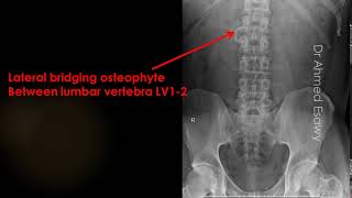 case 604 Lateral bridging osteophyte [upl. by Niwrad]