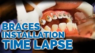 Braces Installation Time Lapse What to expect when getting braces [upl. by Yobybab239]