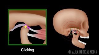 Temporomandibular Joint TMJ Anatomy and Disc Displacement Animation [upl. by Okier390]