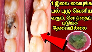 சொத்தைப் பல்லில் வைத்தஅடுத்த நொடியில் பல் புழு வெளிய வரும்100Result ❣tooth cavity in tamil [upl. by Anailuig370]