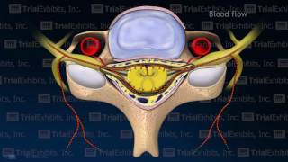 Arterial Vasospasm with Resulting Embolic Stroke [upl. by Gniliem60]