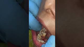 lingually erupted tooth extraction by 18 years experianced dentist in Patna  Dr Abhishek Kumar [upl. by Aelaza]