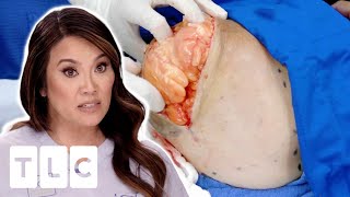 Woman With ELEPHANT SKIN Slaps Her Body To Avoid Irritation  Dr Pimple Popper [upl. by Trimmer]