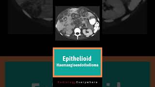 Epithelioid Haemangioendothelioma of the liver  Radiology tutorials  video 58 [upl. by Libnah]