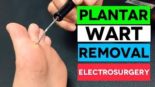 FAST Plantar Wart Removal By Electrosurgery [upl. by Nehemiah276]