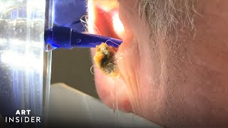 Water Device Painlessly Removes Earwax  Art Insider [upl. by Auhs]