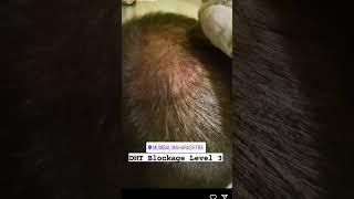 Hijama hair loss stop and new hair growth sortvideo viralshort maharashtra mumbai viralvideo [upl. by Barbee]