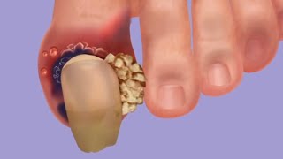 ASMR treatment for ingrown nail remove worms infected with legs treat and remove dameged toenail [upl. by Gaeta]