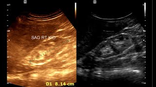 Chronic Kidney Disease  Pylonephritis [upl. by Hairahcaz221]