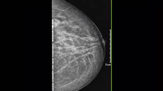 CASE 192 left breast intramammary lymphadenopathy [upl. by Levon]