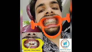 FULL BRACES JOURNEY FROM STARTING TO END PAINLESS BRACES TREATMENT BY DR AKHILESH MULCHANDANI [upl. by Sami]