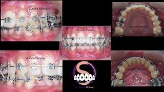 Bimaxillary protrusion treated without extraction🤔 Mostafa Elshafey [upl. by Odine2]