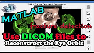 【MATLAB  3D Reconstruction】Using DICOM files to reconstruct patients eye orbit [upl. by Omiseno]