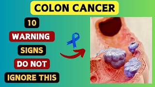 Warning Don’t Ignore These 10 Early Signs of Colon Cancer [upl. by Lothario]