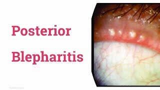 Posterior Blepharitis [upl. by Audette]