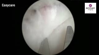 Synechiae removal with EasyCare [upl. by Hajar]