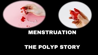 Polyps  Endometrial  Cervical  Abnormal uterine bleeding  Heavy menses  Causes [upl. by Tynan]