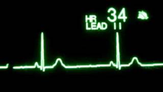 Sinus Bradycardia [upl. by Atnauqahs89]