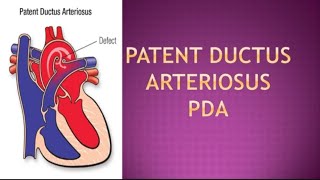 Patent ductus arteriosusPDAheart disorder [upl. by Chuch]