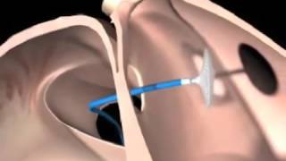 Atrial Septal Defect Surgery India  Transmedglobalcom [upl. by Atalaya]