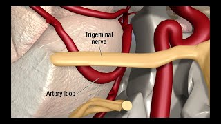 Treatment for Trigeminal Neuralgia UCSF Neurosurgery [upl. by Aubrie]