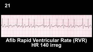 ECG Rhythm Recognition Practice  Test 1 [upl. by Auqinot]