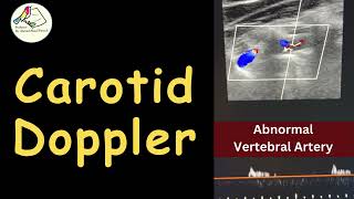 Carotid amp Vertebral Doppler  Carotid Atheroma Abnormal VA  Case story [upl. by Airotel]