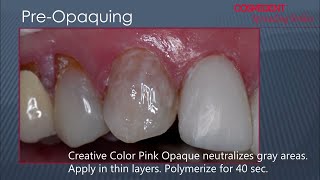 Composite Veneers  Layer that counts [upl. by Macfadyn]