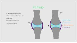 Septic  Infectious arthritis Essential medicine [upl. by Raney901]