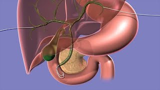 Your Biliary Drain [upl. by Alford]