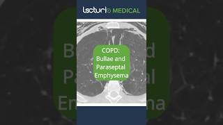 🔍 CT Scan Insights Bullae amp Paraseptal Emphysema EmphysemaInsights RadiologyRevealed usmle [upl. by Lezti]