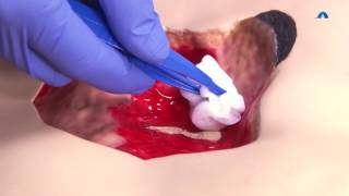 How to Effectively Cleanse and Debride a Wound  Wound Cleansing and Debridement  Ausmed Education [upl. by Killam624]