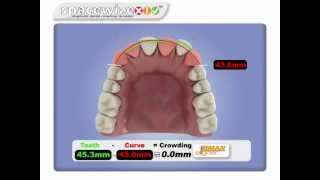 Spacewize Dental Crowding Calculator [upl. by Lossa]