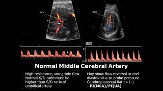 Fetal Middle Cerebral Artery Doppler Ultrasound Normal Vs Abnormal Image Appearances  MCA USG [upl. by Brok]