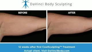 CoolSculpting Arms Treatment Real Before amp After Results [upl. by Penny629]