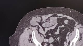 Spigelian hernia causing small bowel obstruction CT findings [upl. by Levey]