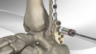 Enkel fractuur operatieve behandeling fibula [upl. by Lleval]