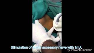 Ultrasound guided spinal accessory nerve block [upl. by Carlie]